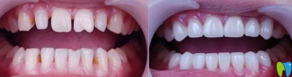 北京瑞泰口腔全瓷牙修復牙齒效果