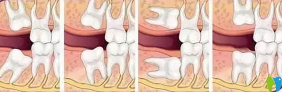 口腔智齒生長位置圖