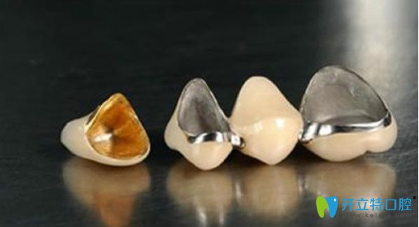 鑲一顆烤瓷牙多少錢 有人說門牙做全瓷牙后有臭味是真的嗎
