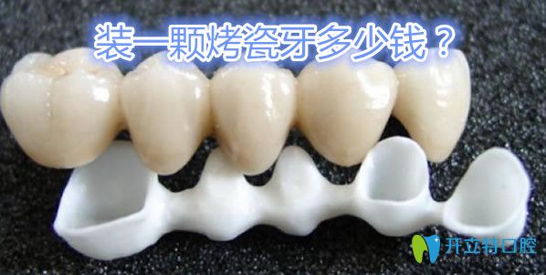 烤瓷牙的價格在600元—5000元左右