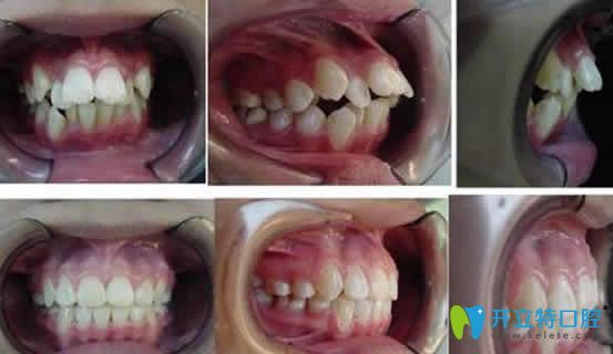  武漢優(yōu)益佳口腔牙齒矯正效果對比圖