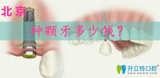 北京做種植牙多少錢?請(qǐng)看韓國奧齒泰和瑞士iti種植體價(jià)格表