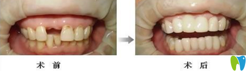 英博口腔門牙缺失種植牙案例對比圖 英博口腔門牙缺失種植牙案例對比圖
