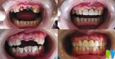 青島天皓口腔門診種植牙效果對比圖 青島天皓口腔門診種植牙效果對比圖