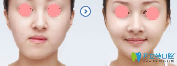 成都西區(qū)口腔科偏頜矯正帶牙套矯正前后對比效果 成都西區(qū)口腔科偏頜矯正帶牙套矯正前后對比效果
