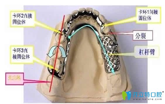 分享2024可摘局部義齒優(yōu)缺點及活動假牙價格