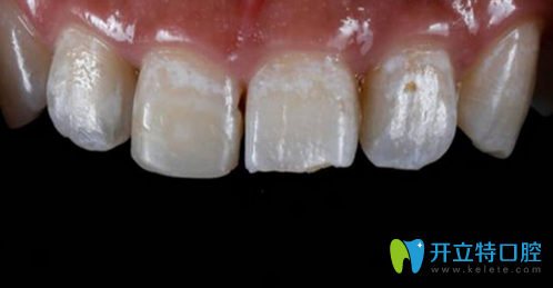 門牙斷裂怎么修復(fù)?看孫周口腔為顧客做樹脂填充修復(fù)全過程