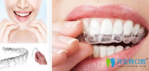 泉州維樂口腔楊華介紹隱形牙齒矯正優(yōu)勢