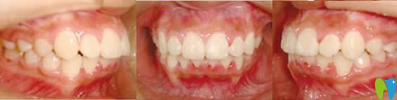 青島天皓口腔11歲孩子牙齒正畸后照片 青島天皓口腔11歲孩子牙齒正畸后照片