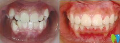 11歲女兒在青島天皓口腔做牙齒矯正的經(jīng)歷和體驗(yàn)分享