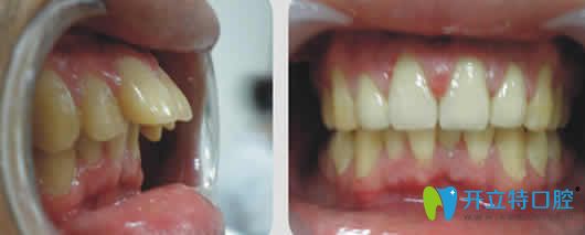 新疆凱樂口腔齙牙矯正前后效果對(duì)比圖