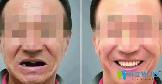 烏魯木齊凱樂口腔種植牙效果圖