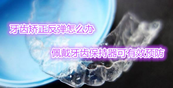 牙齒矯正一定要佩戴牙齒保持器嗎 保持器怎么清洗+注意事項