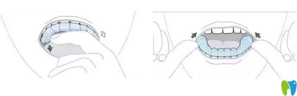 牙套的摘除方法
