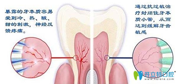 急性牙髓炎怎么治療搶先看 錯(cuò)過(guò)治療讓你后悔莫及