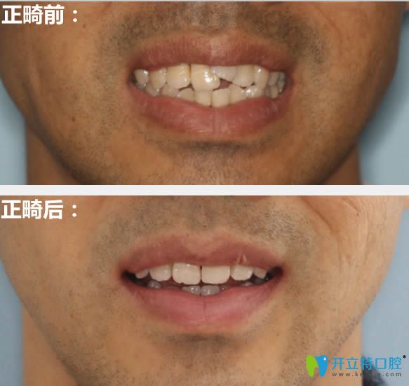 成都西區(qū)口腔28歲矯正牙齒前后對比照 成都西區(qū)口腔28歲矯正牙齒前后對比照