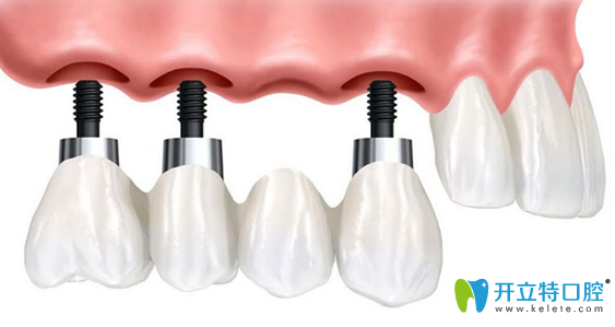 種植牙到底好不好，該不該做