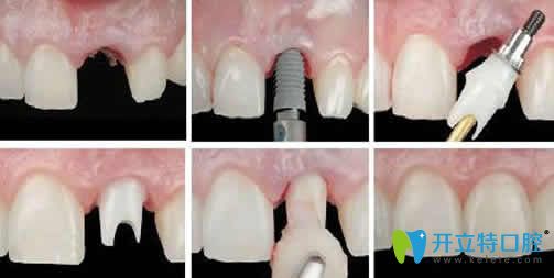 寧波現代口腔種植牙案例效果圖