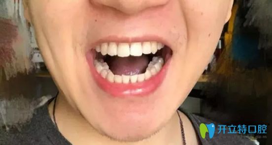 閆路做牙齒矯正摘掉牙套之后照片