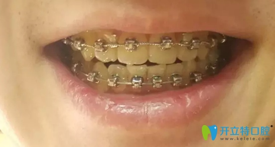 華美口腔摘牙套前較后一次復診