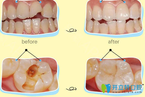 華美楊松補(bǔ)牙治療術(shù)前術(shù)后對(duì)比案例 華美楊松補(bǔ)牙治療術(shù)前術(shù)后對(duì)比案例