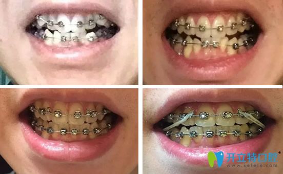 合肥華美口腔牙齒矯正2年間變化過程圖展示