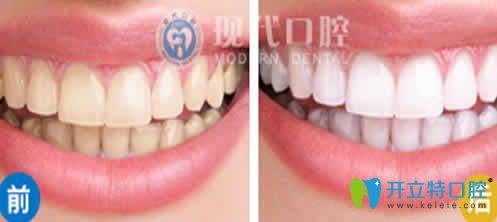 寧波現代口腔牙齒美白前后對比圖