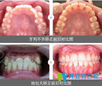 閆路牙齒矯正真人案例 閆路牙齒矯正真人案例