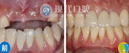 寧波現(xiàn)代口腔陳敬達種植牙案例效果圖 寧波現(xiàn)代口腔陳敬達種植牙案例效果圖