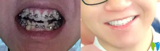 在合肥華美口腔做牙齒矯正前后的對比圖