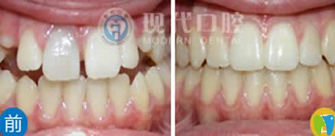 寧波北侖現代口腔隱形牙齒矯案例效果圖正