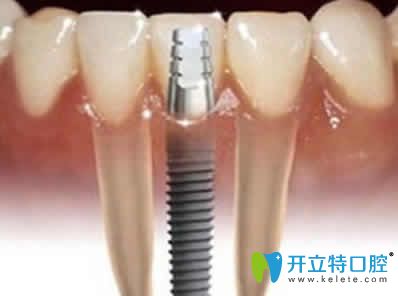 新疆凱樂(lè)口腔種植牙
