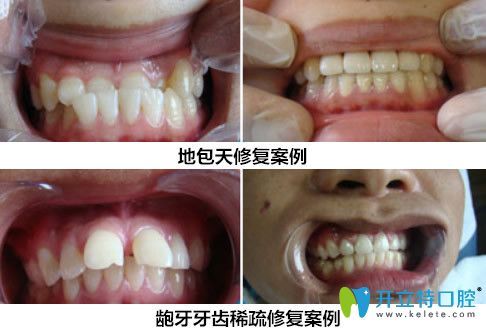 趙艷牙齒修復(fù)案例 趙艷牙齒修復(fù)案例
