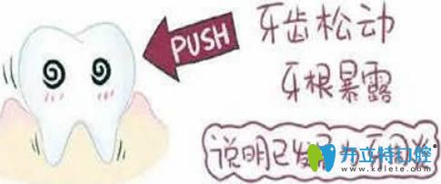 開立特牙齒松動(dòng)怎么治療之牙周炎圖片