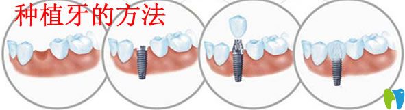 種植牙的方法