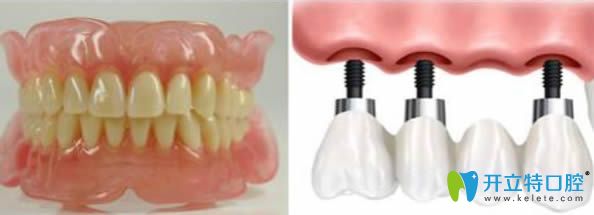 關(guān)于鑲牙好還是種牙好請(qǐng)看這里