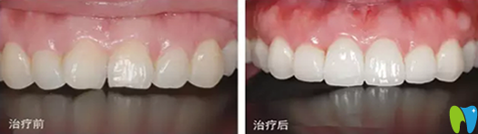 嘉興曙光口腔牙齒美容冠修復治療前后對比圖