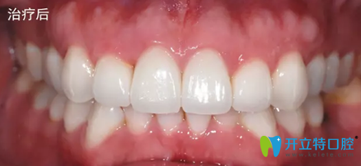找嘉興曙光口腔趙艷做牙齒修復治療后圖片