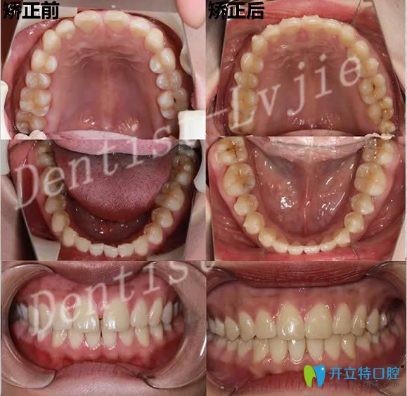 北京圣貝口腔劉雪蓮牙齒矯正前后對(duì)比照