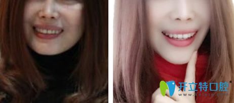 從重慶樂樂欣段斌牙齒矯正案例來看牙齒正畸對臉型的影響