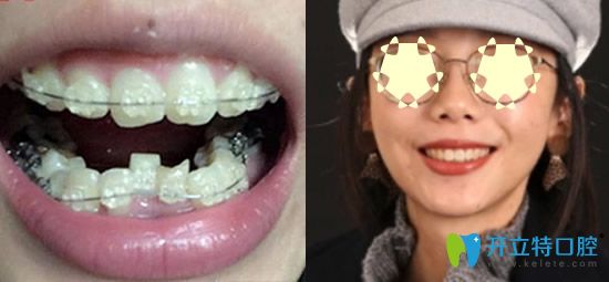  重慶整牙哪家？看重慶樂樂欣口腔牙齒矯正真人案例
