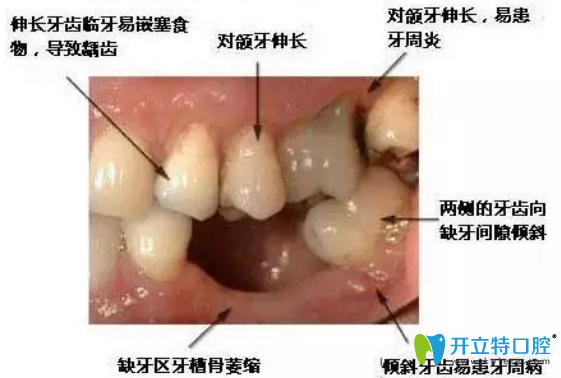 拔牙后鑲牙有沒有時間？