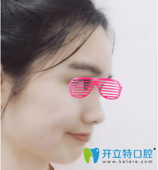 矯正牙齒12個月<span style=