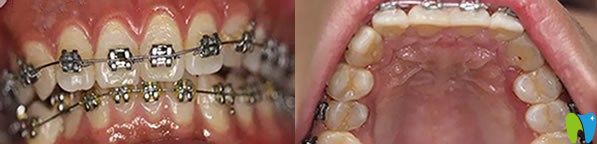 牙齒矯正三個月的恢復(fù)效果圖