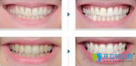 長(zhǎng)沙雅美口腔牙齒冷光美白前后效果對(duì)比圖 長(zhǎng)沙雅美口腔牙齒冷光美白前后效果對(duì)比圖