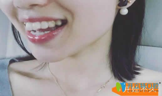 長沙雅美口腔劉景醫(yī)生剛開始給我做隱形牙齒矯正照片