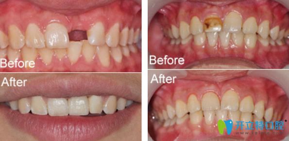 維樂口腔種植牙及色素牙修復(fù)效果對比圖 維樂口腔種植牙及色素牙修復(fù)效果對比圖