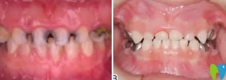 新疆凱樂口腔曾虹兒童牙齒治療前后對(duì)比圖