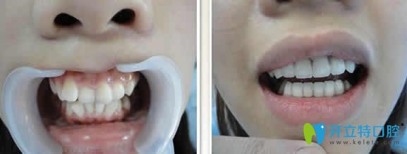 長(zhǎng)沙牙大夫口腔周權(quán)牙齒矯正案例效果圖