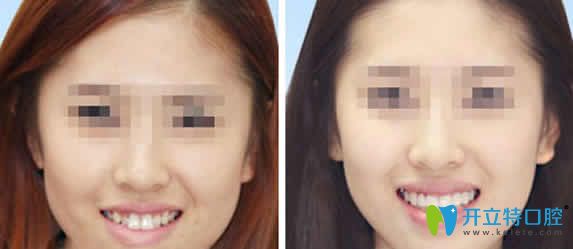長沙牙大夫口腔牙齒矯正案例效果圖